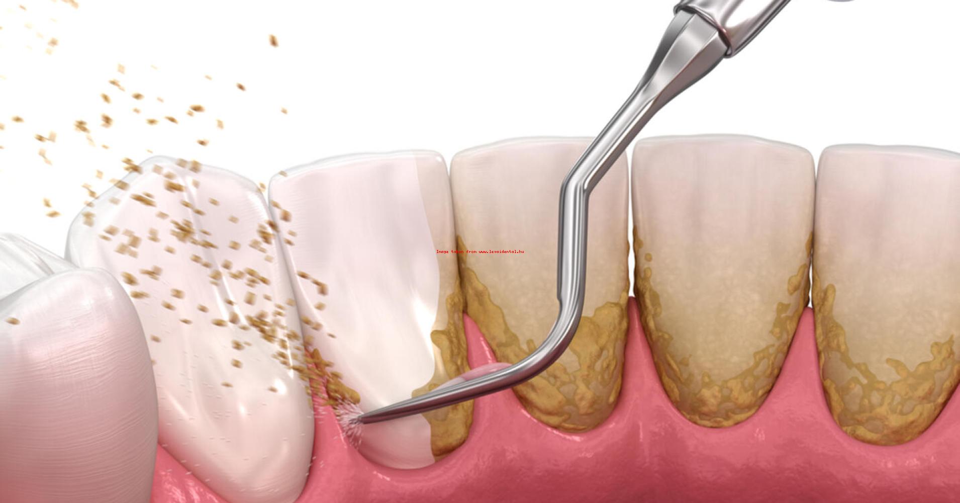 Fogk elt vol t s rak L vai Dental Fog szat