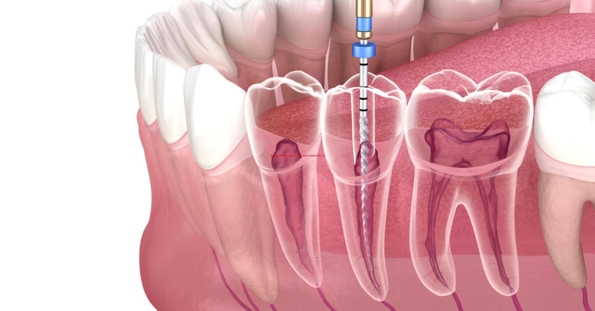 Gy k rkezel s rak Budapesten L vai Dental Fog szat